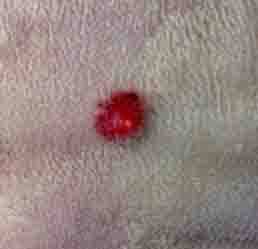 Dog Mast Cell Tumor Information and dogskinpimples 3