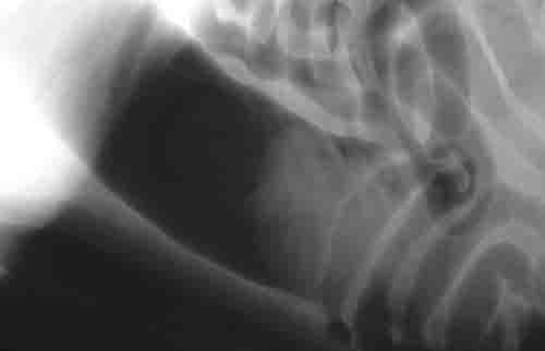 bowel obstruction in dogs stomach blockage and gastric outflow obstruction bowel obstruction in dogs stomach blockage and gastric outflow obstruction