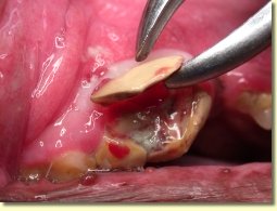 How is an abscessed tooth treated?