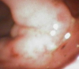 dog gastric adenocarcinoma and ulcer - example 1 - 254px x 222px