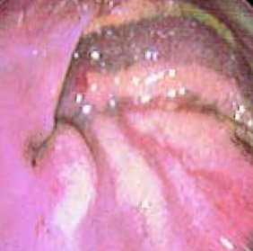 gastritis in dogs - endoscopy image 2 - 282px x 279px