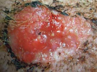 Canine Squamous Cell Carcinoma Canine Squamous Cell Carcinoma