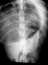 Dog Gastric Dilation Xray Dog Gastric Dilation Xray