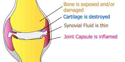 Immune Mediated Arthritis Diagram