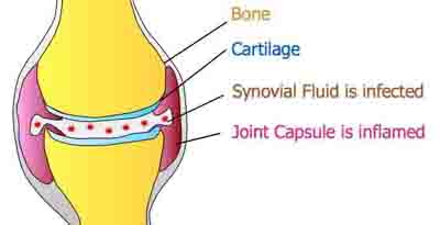 Infectious Arthritis Diagram