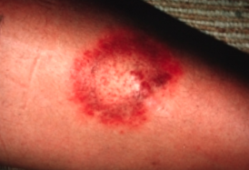 picture of lyme disease in dogs picture of lyme disease in dogs
