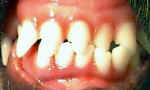 Canine Teeth: Orthodontic Treatment Canine Teeth: Orthodontic Treatment