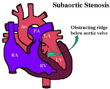dog subaortic stenosis