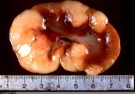 Canine Lymphosarcoma on Dog Kidney