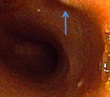 View of Inside Dog's Small Intensine Using an Endoscopy
