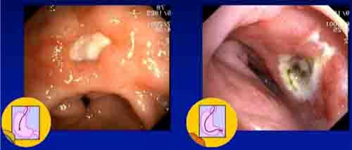 Dog Gastric Ulceration - 2 Images