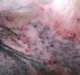 Dog Skin Lumps Due to Bacterial Infection Dog Skin Lumps Due to Bacterial Infection