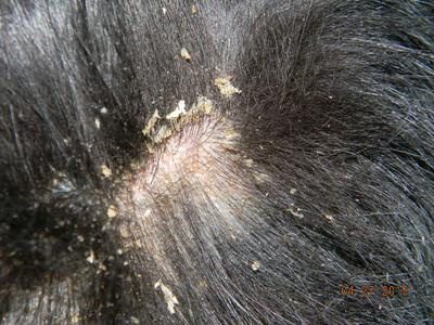 Dog Hair Dandruff