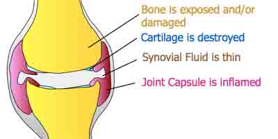 Immune Mediated Arthritis Diagram Immune Mediated Arthritis Diagram
