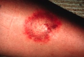 picture of lyme disease in dogs