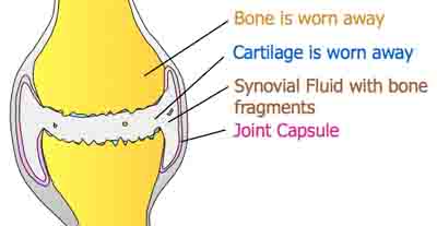 Osteoarthritis Joint Diagram