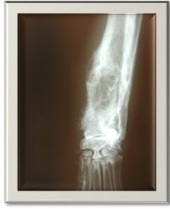 X-ray - Canine Osteosarcoma Treatment X-ray - Canine Osteosarcoma Treatment