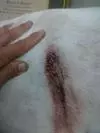 This is another picture of the blister that opened up this morning