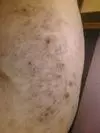 this is a picture of some of his old scars from these blisters